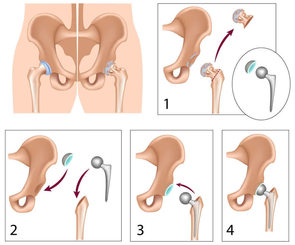 Total Hip Replacement Diagram
